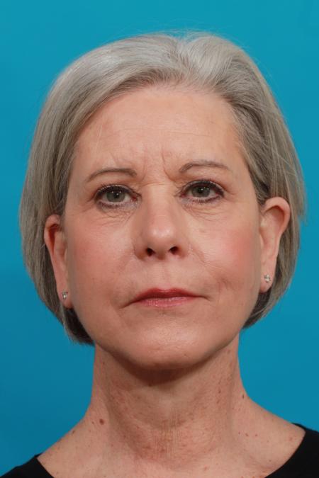 After image 1 Case #103976 - Face Lift / Quad Bleph