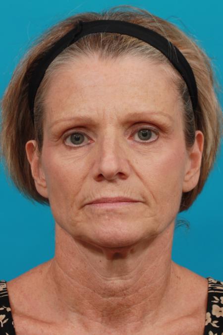 Before image 1 Case #104046 - Neck Lift