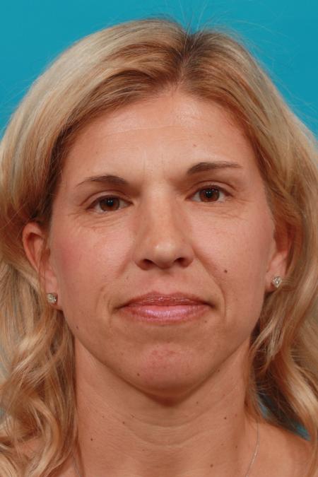 After image 1 Case #104216 - Blepharoplasty