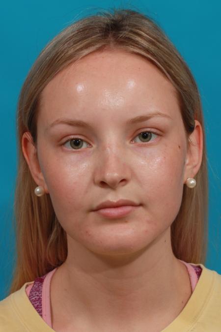 After image 1 Case #104371 - Rhinoplasty