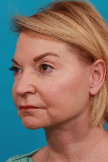 After image 2 Case #104031 - Face Lift