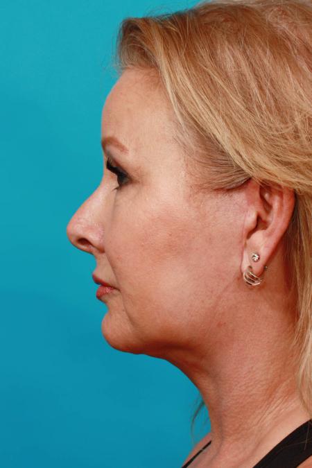 After image 3 Case #103916 - Face Lift