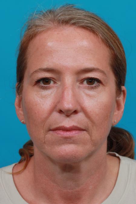 Before image 1 Case #104091 - Blepharoplasty