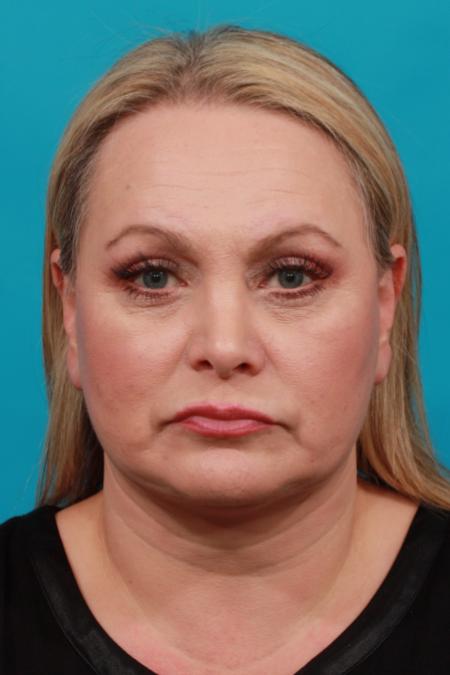 After image 1 Case #103961 - Facial Rejuvenation