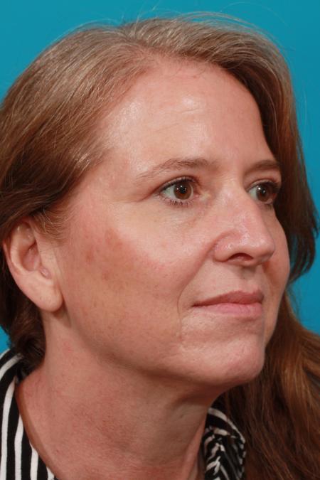 After image 2 Case #104091 - Blepharoplasty