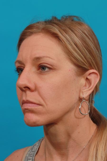 After image 2 Case #104026 - Blepharoplasty