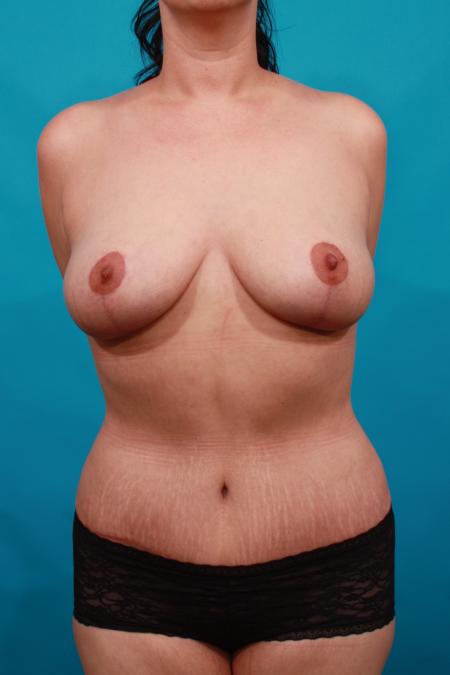 After image 1 Case #104296 - Mommy Makeover: TT / BL / SAL