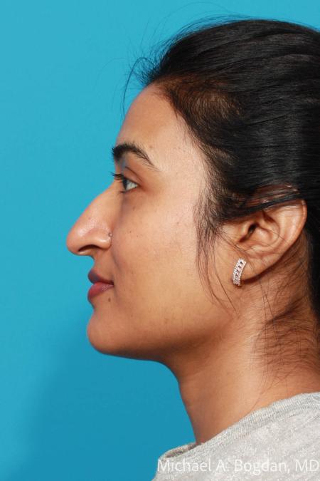 Before image 3 Case #103876 - Rhinoplasty