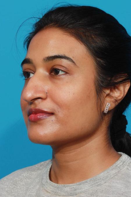 Before image 2 Case #103781 - Rhinoplasty