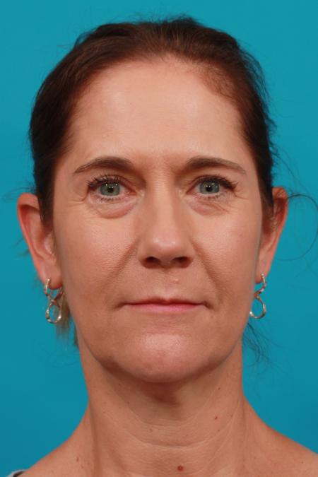 Before image 1 Case #104241 - Blepharoplasty