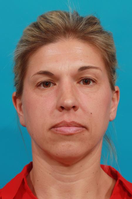Before image 1 Case #104216 - Blepharoplasty