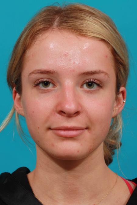 Before image 1 Case #103736 - Rhinoplasty