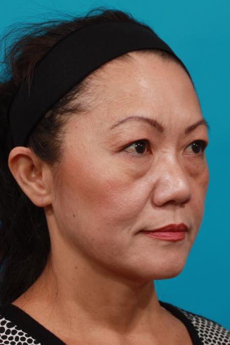 Before image 2 Case #104011 - Blepharoplasty