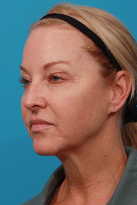 Before image 2 Case #103726 - Facelift