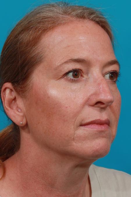 Before image 2 Case #104091 - Blepharoplasty