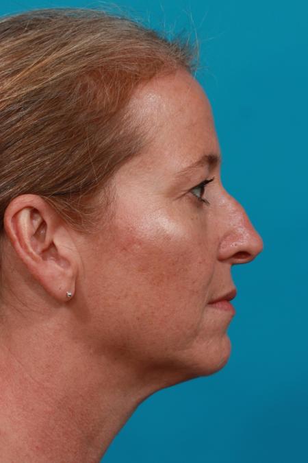 Before image 3 Case #104091 - Blepharoplasty
