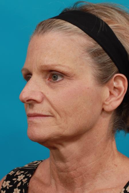 Before image 2 Case #104046 - Neck Lift
