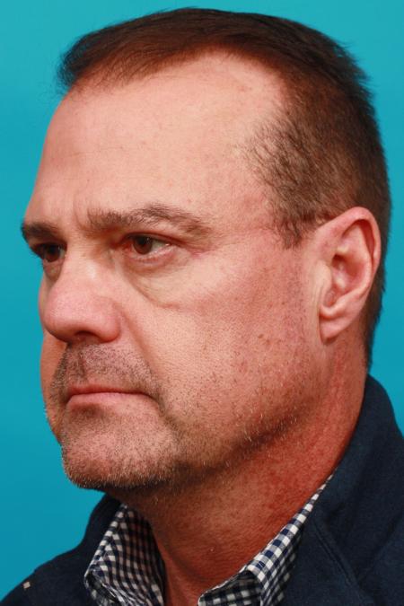 After image 2 Case #104181 - Blepharoplasty