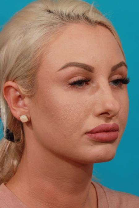 Before image 2 Case #104136 - Rhinoplasty