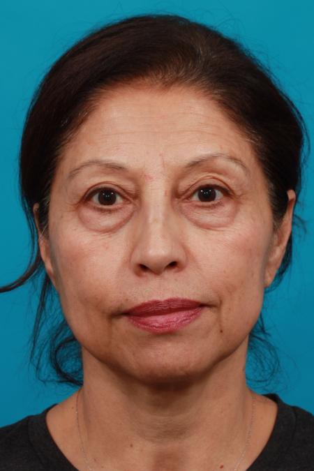 Before image 1 Case #104381 - Blepharoplasty