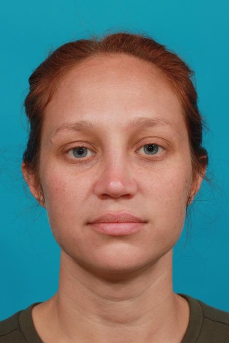 After image 1 Case #104006 - Rhinoplasty