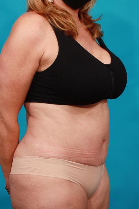 After image 2 Case #104066 - Tummy Tuck: SAL