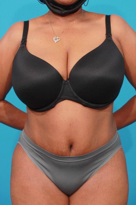 After image 1 Case #103831 - Tummy Tuck