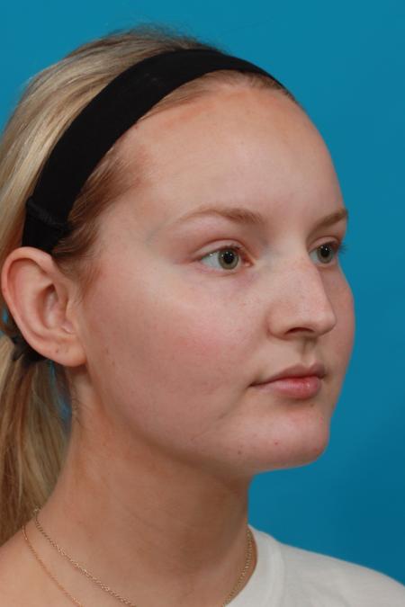 Before image 2 Case #104371 - Rhinoplasty