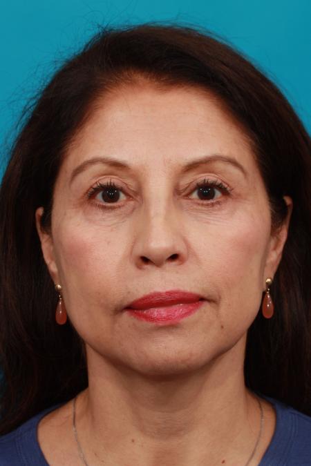 After image 1 Case #104381 - Blepharoplasty