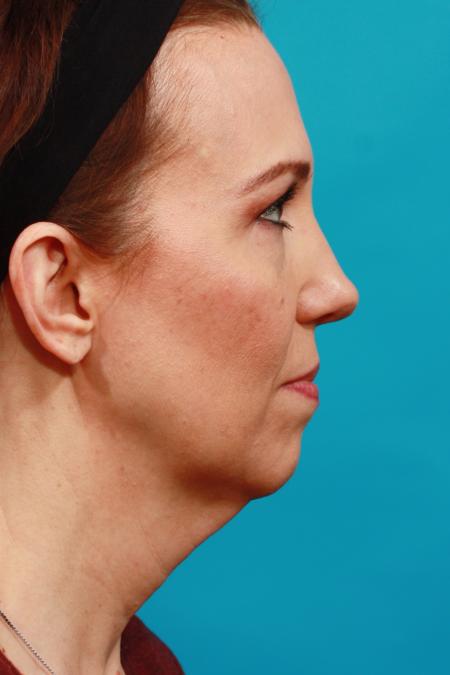 Before image 3 Case #104226 - Face Lift