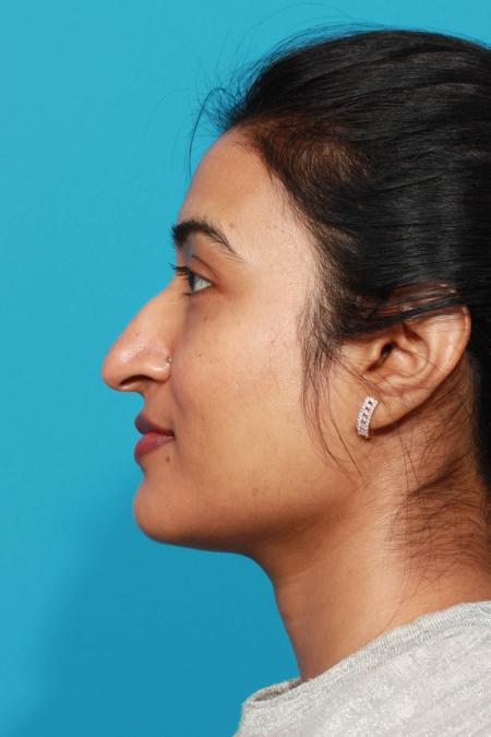 Before image 3 Case #103781 - Rhinoplasty