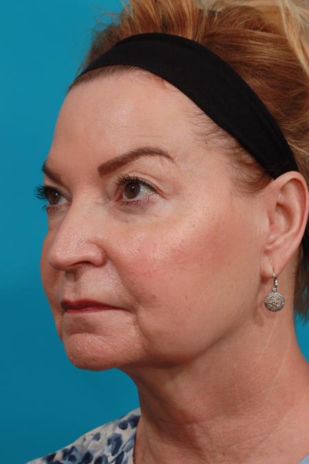 Before image 2 Case #104031 - Face Lift