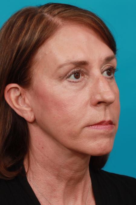 After image 2 Case #103996 - Neck Lift