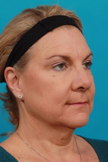 Before image 2 Case #104271 - Neck Lift