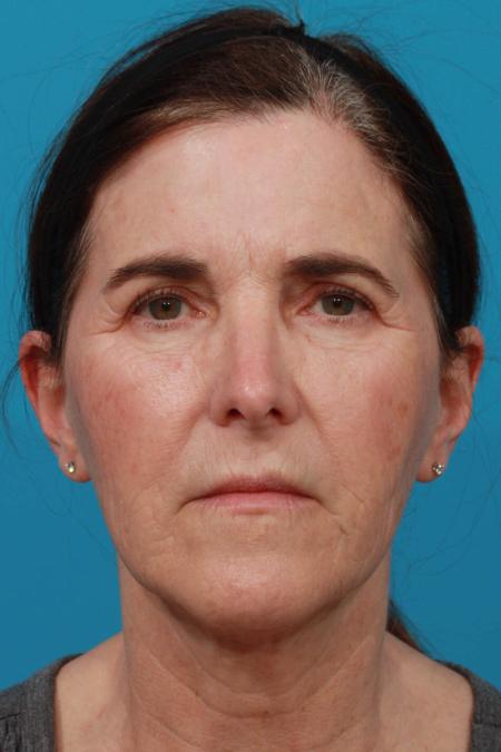 Before image 1 Case #103806 - Face Lift and Brow Lift
