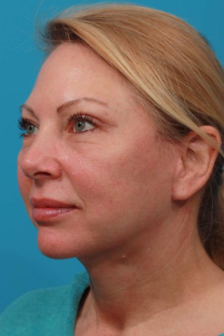 After image 2 Case #103866 - Face Lift