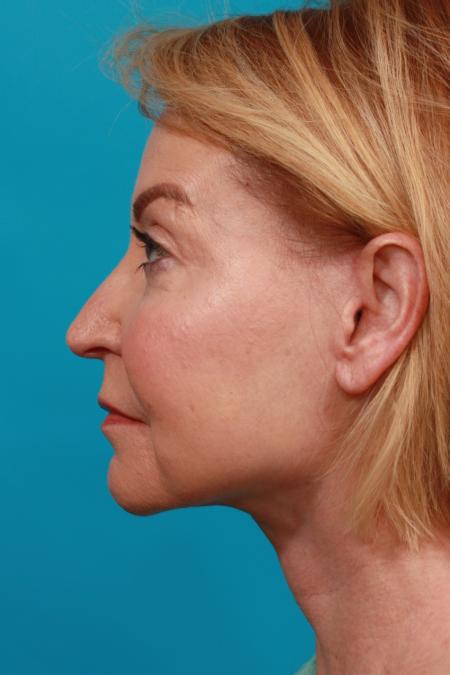 After image 3 Case #104031 - Face Lift