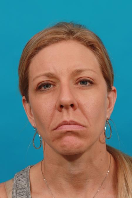 After image 1 Case #104026 - Blepharoplasty