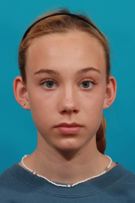 Before image 1 Case #104121 - Otoplasty