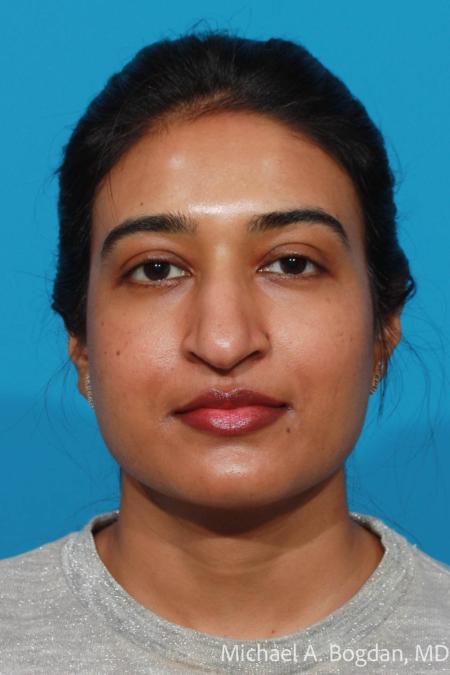 Before image 1 Case #103876 - Rhinoplasty