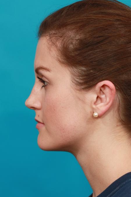 After image 3 Case #104201 - Otoplasty