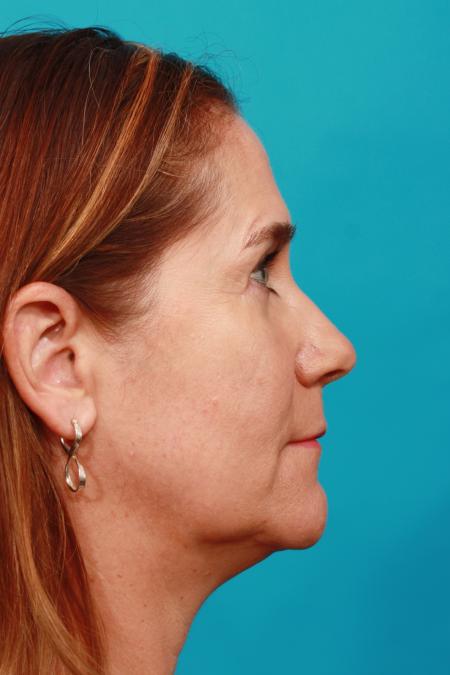 After image 3 Case #104241 - Blepharoplasty