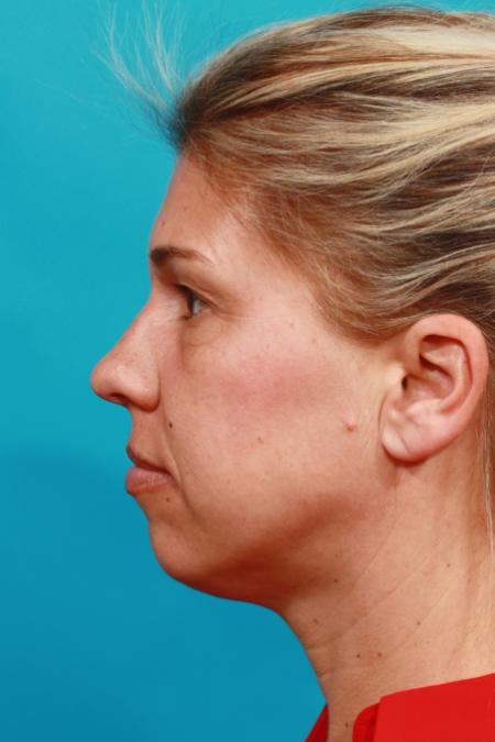 Before image 3 Case #104216 - Blepharoplasty