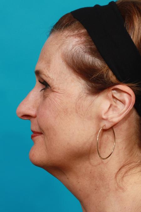 Before image 3 Case #104081 - Facial Rejuvenation