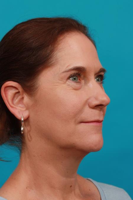 Before image 2 Case #104241 - Blepharoplasty