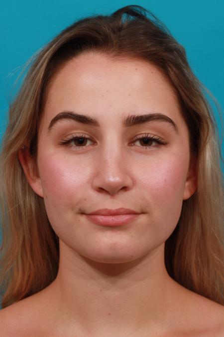 After image 1 Case #104326 - Rhinoplasty