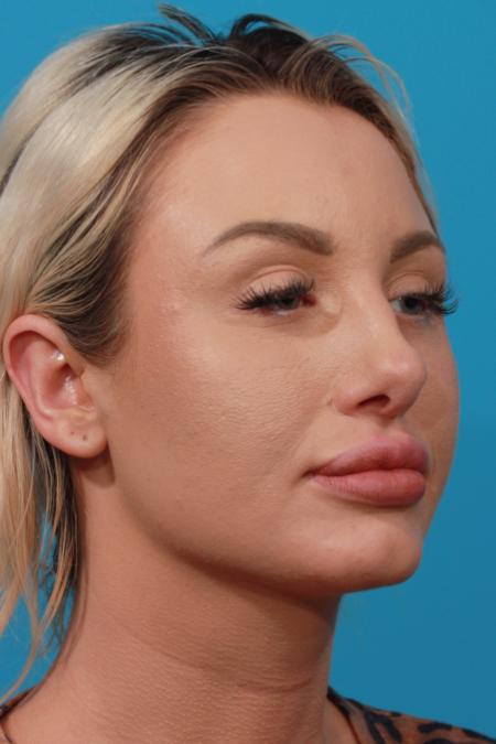 After image 2 Case #104136 - Rhinoplasty