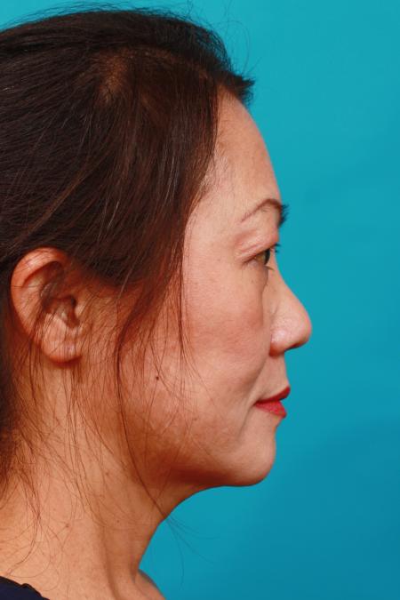 After image 3 Case #104011 - Blepharoplasty