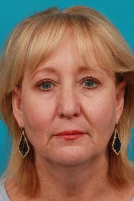 After image 1 Case #104171 - Blepharoplasty
