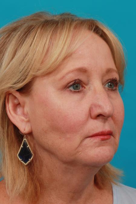 After image 2 Case #104171 - Blepharoplasty